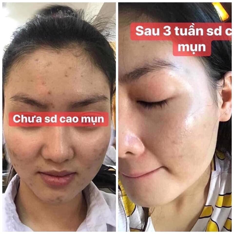 Cao mụn sâm đỏ MEEA